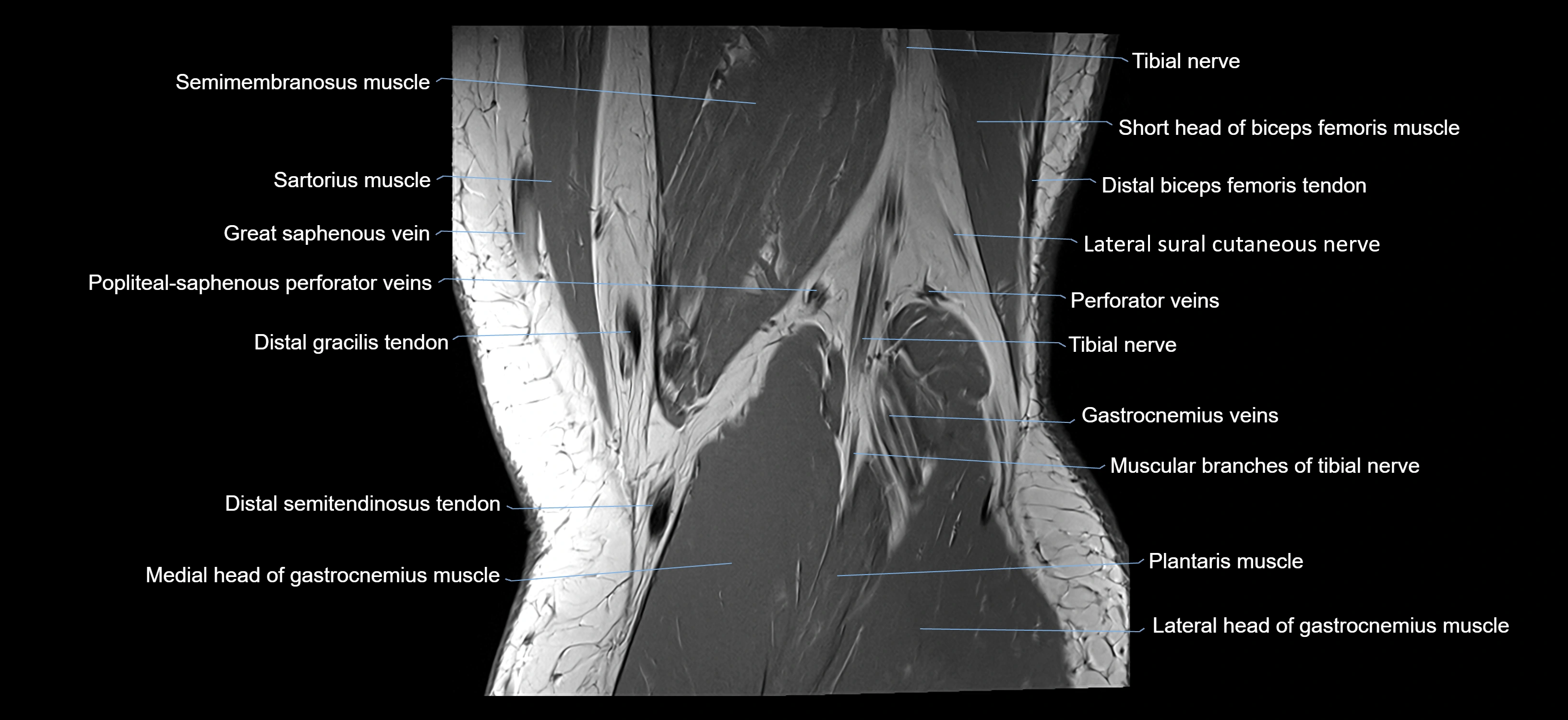 MRI knee coronal cross sectional anatomy labelled 3T radiology  image-04001-00037.webp